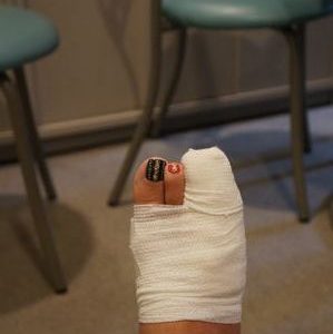 ５０歳にて初骨折