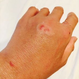 散歩中犬に噛まれて・・・